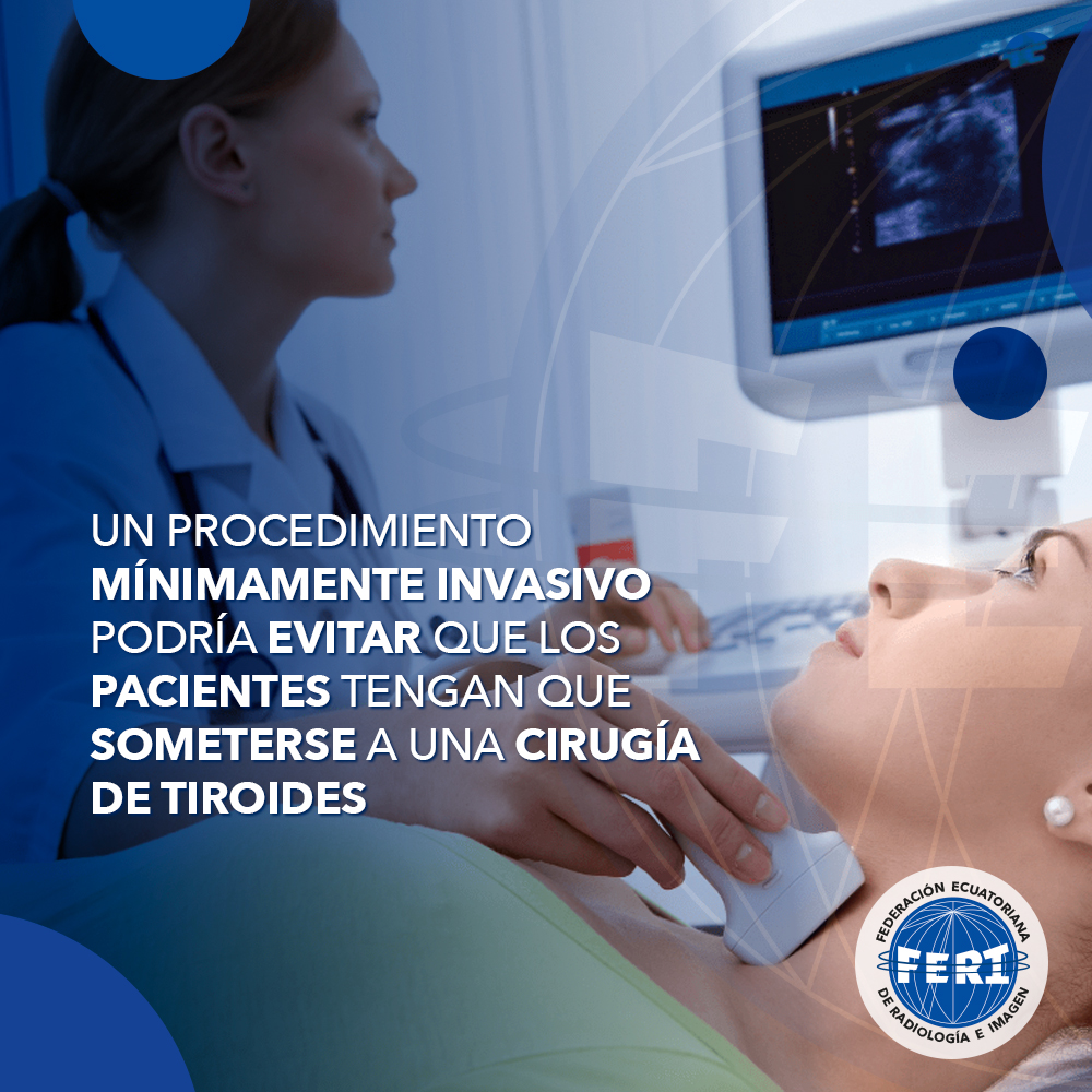 Un procedimiento mínimamente invasivo podría evitar que los pacientes tengan que someterse a una cirugía de tiroides